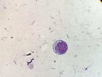 Burkitt's lymphoma in ascitic fluid