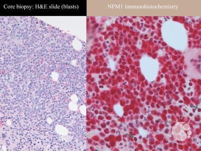 NPM1-mutated IHC staining pattern