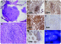 Reverse variant of follicular lymphoma: uncommon morphology in a common lymphoma