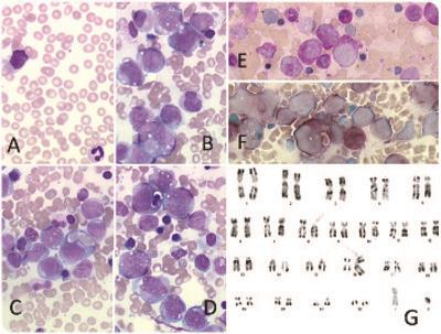 Acute myeloid leukemia with erythrophagocytosis indicative of KAT6A rearrangement