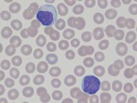 CLL trisomy 12 1