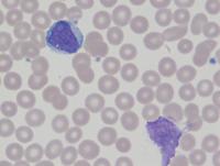 CLL trisomy 12 2