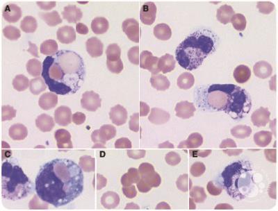 Florid erythrophagocytosis by neutrophils in peripheral blood