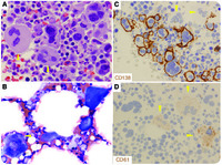 Mimics of megakaryocytes: giant bizarre myeloma cells