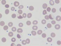 Blister cells 1