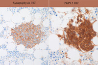 Immunostains-Neuroblastoma