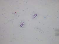 Strongyloides Stercoralis (Image A)