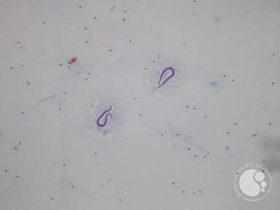 Strongyloides Stercoralis (Image A)