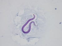 Strongyloides Stercoralis (image B)