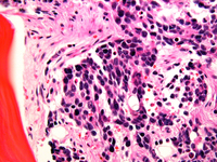 Alveolar rhabdomyosarcoma BMBx 1