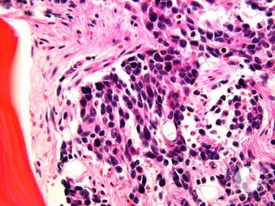 Alveolar rhabdomyosarcoma BMBx 1