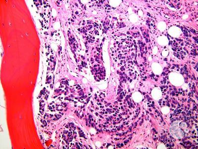 Alveolar rhabdomyosarcoma BMBx 2