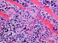 Alveolar rhabdomyosarcoma Alveolar rhabdomyosarcoma forearm mass