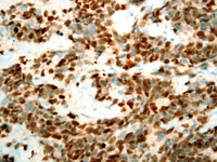 Alveolar rhabdomyosarcoma myogenin nuclear immunoreactivity