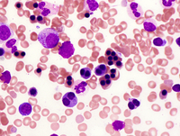 Congenital Dyserythropoietic Anemia (CDA) type II 1