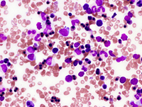 Congenital Dyserythropoietic Anemia (CDA) type II 2