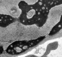 CDA type I EM images Swiss cheese chromatin actually higher magnification