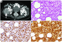 Parathyroid hormone–related protein-producing cyclin D3–positive blastoid variant of mantle cell lymphoma with hypercalcemia