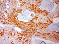 Myeloid leukemia of Down syndrome CD61 immunostain