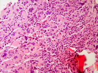 Myeloid leukemia of Down syndrome core biopsy intermediate power