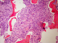 Myeloid leukemia of Down syndrome core biopsy low power