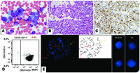 Metastatic rhabdomyosarcoma initially diagnosed on the bone marrow