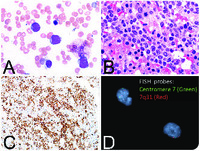 Hepatosplenic T-cell lymphoma with blastoid morphology in a patient with Crohn disease