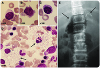 Morphology of Wolman cholesteryl ester storage disease