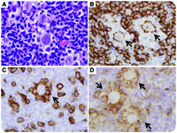 Tcell rosettes in nodular lymphocytepredominant Hodgkin