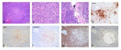 Plasmacytoid dendritic cells in lupus