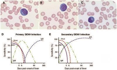 Plasmacytoid lymphocytes: a clue to dengue diagnosis