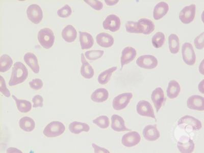 Tear drop cells (Dacrocytes) 1