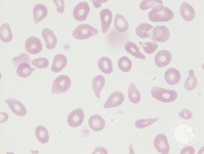 Tear drop cells (Dacrocytes) 2