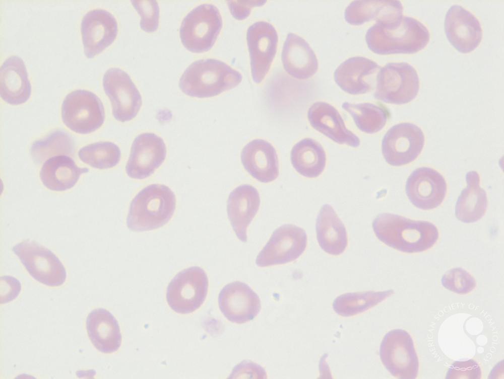Tear drop cells (Dacrocytes) 2