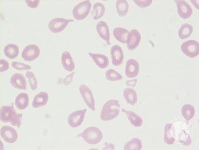 Tear drop cells (Dacrocytes) 3