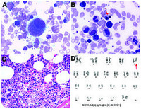 MDS with isolated del(5q)