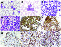 Cyclin D1–negative blastoid mantle cell lymphoma exhibiting cleaved to bilobated cytomorphology