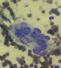 Bone marrow metastasis