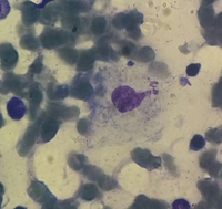 Gauchers disease essay image