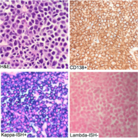 Plasmacytoma