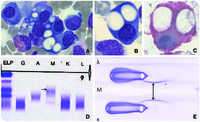 Morphologic features of μ-heavy-chain disease