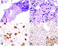 Incidental brown adipose tissue in bone marrow biopsy