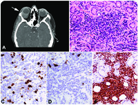 Relapse of an acute leukemia of mixed lineage as an isolated orbital mass