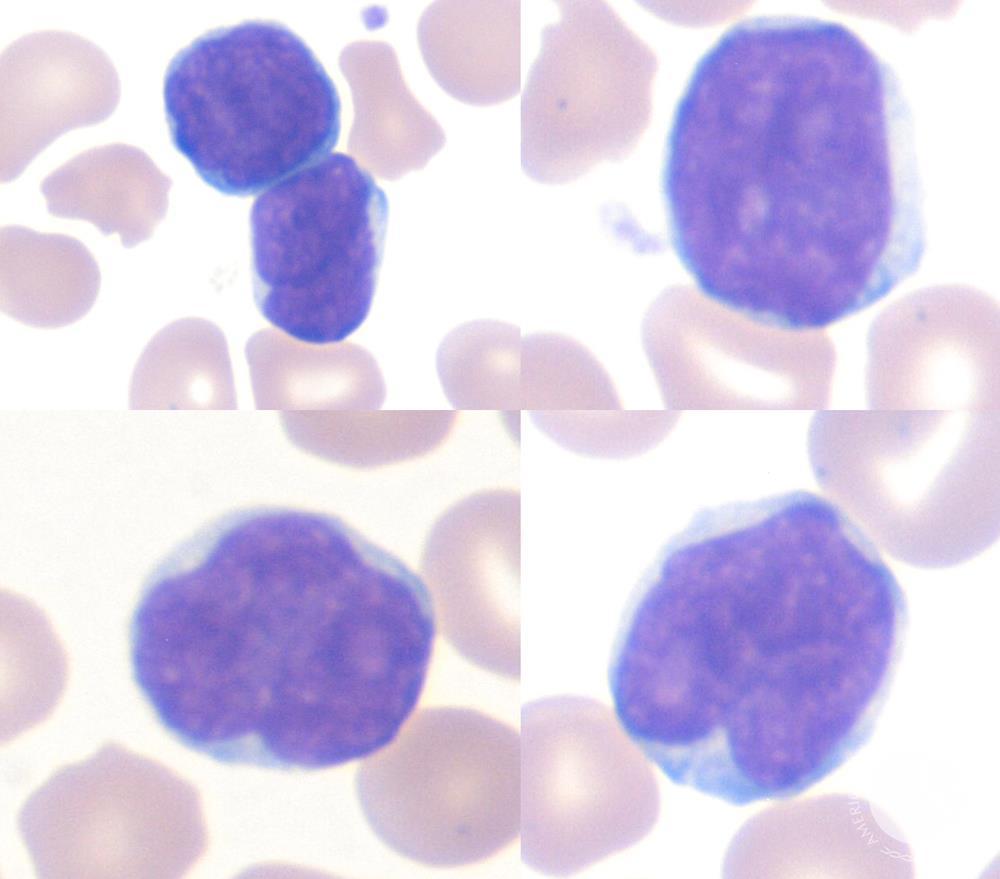 Pediatric lymphocytes