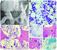 Coexistence of multiple myeloma and Paget disease of bone