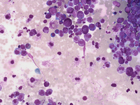 Mast cell Leukemia