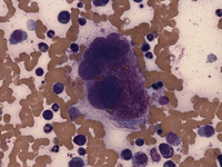 Mast cell Leukemia