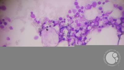 microfilaria in marrow particles 2