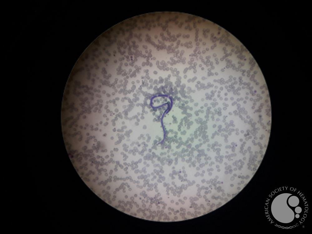 Microfilaria seen in same case in peripheral blood smear.