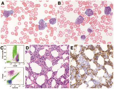 Leukemic presentation of diffuse large B-cell lymphoma: an unusual pattern associated with splenic involvement